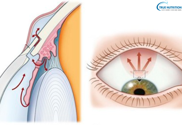 Bệnh glôcôm là gì? Những điều cần biết để bảo vệ thị lực của bạn