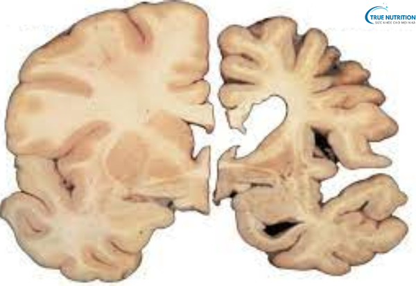 Bệnh Huntington Là Gì? Nguyên Nhân, Triệu Chứng Và Cách Điều Trị