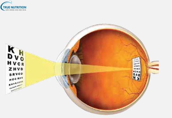 Dấu Hiệu Bệnh Loạn Thị: Tầm Quan Trọng Của Việc Phát Hiện Sớm