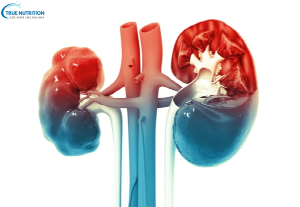 Dấu Hiệu Bệnh Ung Thư Thận: Nhận Biết Sớm Để Chủ Động Điều Trị