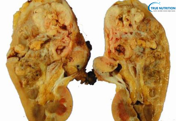 Dấu Hiệu Bệnh Ung Thư Thận: Nhận Biết Sớm Để Chủ Động Điều Trị