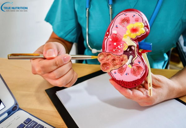 Dấu Hiệu Bệnh Ung Thư Thận: Nhận Biết Sớm Để Chủ Động Điều Trị