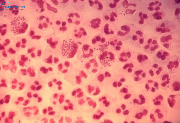 Viêm Niệu Đạo Không Do Lậu Là Gì? Nguyên Nhân Và Cách Điều Trị