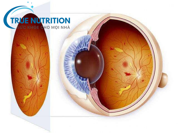 Biến Chứng Mắt Ở Bệnh Nhân Tiểu Đường