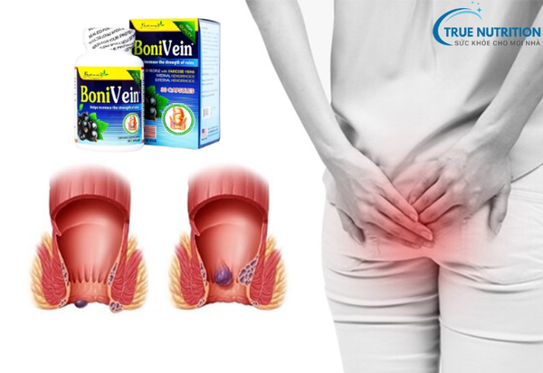 Bonivein 60 Viên Giá Bao Nhiêu: Giải Pháp Hiệu Quả Cho Bệnh Trĩ