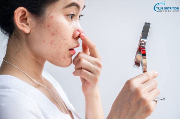 Trị Thâm Mụn Cấp Tốc Sau 1 Đêm: Đơn Giản Và Hiệu Quả