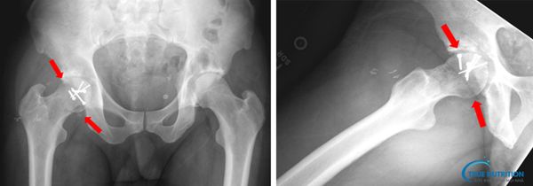 Chỏm Xương Đùi Là Gì? Hoại Tử Chỏm Xương Đùi Là Gì? Dấu Hiệu, Điều Trị, Bài Tập