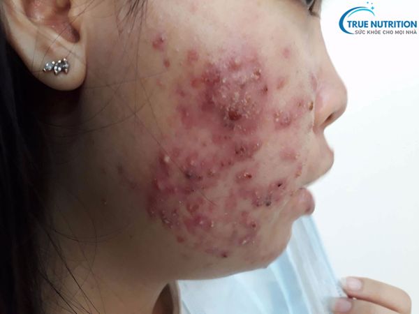 Cách Trị Demodex Tại Nhà: An Toàn Và Hiệu Quả