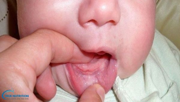 Nhận Diện Hình Ảnh Lợi Trẻ Sắp Mọc Răng: Dấu Hiệu, Chăm Sóc