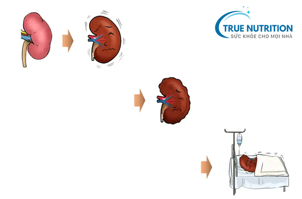 Điều Trị Biến Chứng Tiểu Đường