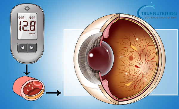 Điều Trị Biến Chứng Tiểu Đường
