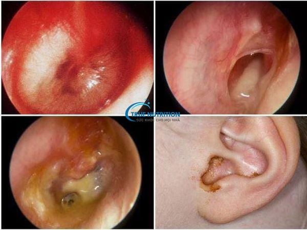 Viêm Tai Giữa Ở Trẻ: Vắc Xin Phế Cầu Và Viêm Tai Giữa