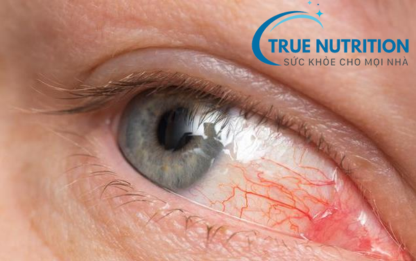 Biến Chứng Mắt Ở Bệnh Nhân Tiểu Đường