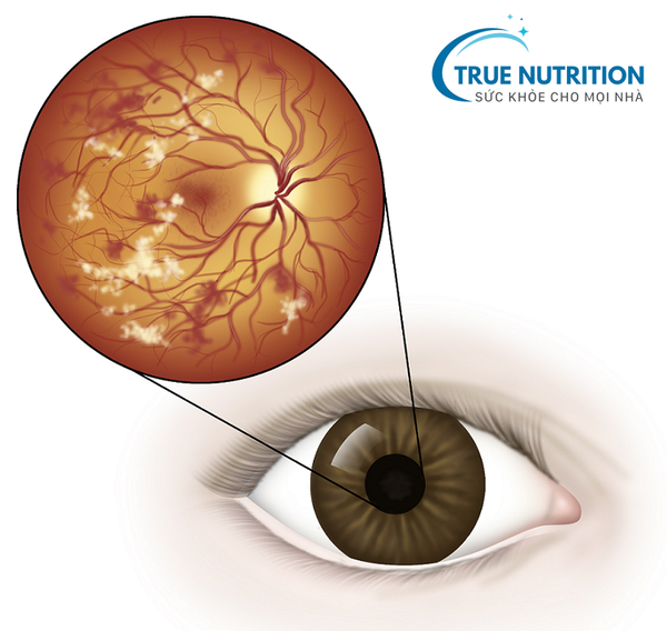 Biến Chứng Mắt Ở Bệnh Nhân Tiểu Đường