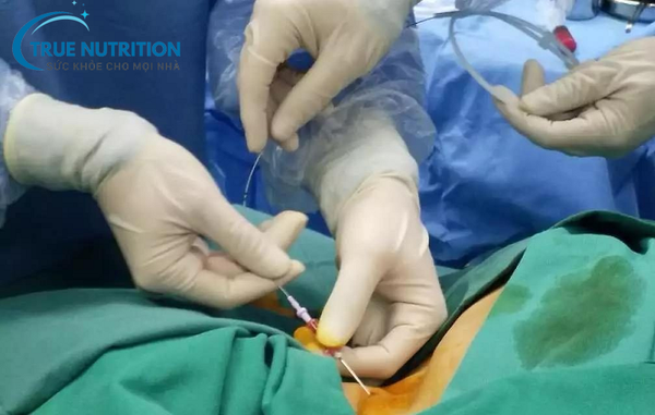 Điều Trị Thoái Hóa Đốt Sống Thắt Lưng