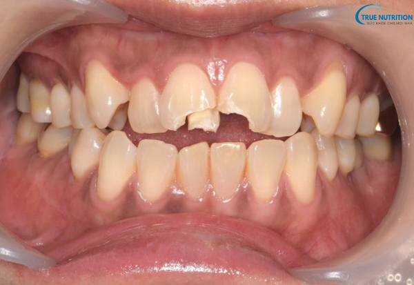 Gãy Răng Cửa Để Lâu Có Sao Không? Đừng Chủ Quan Trước Những Hậu Quả!