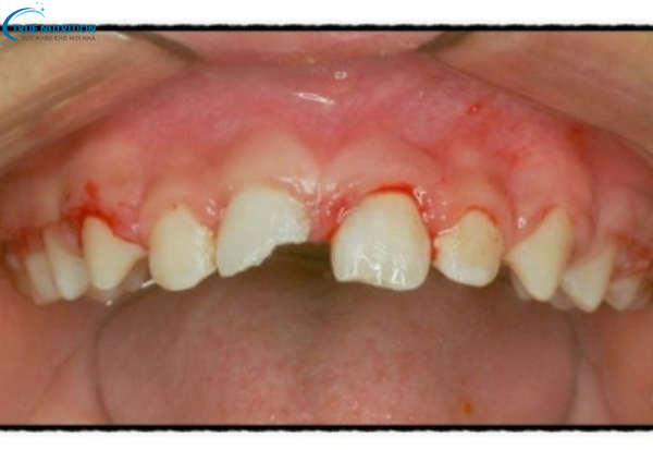 Gãy Răng Cửa Để Lâu Có Sao Không? Đừng Chủ Quan Trước Những Hậu Quả!