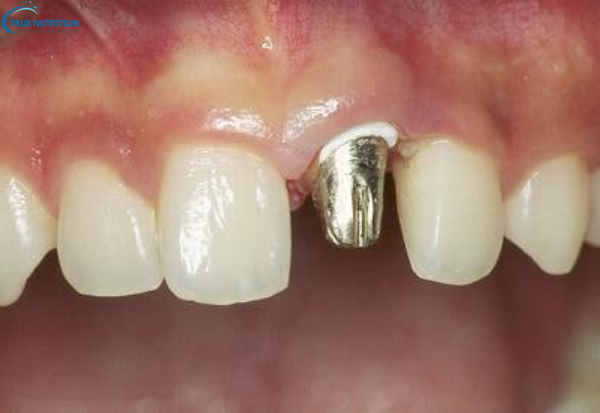 Gãy Răng Cửa Để Lâu Có Sao Không? Đừng Chủ Quan Trước Những Hậu Quả!