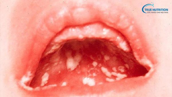 Nổi Mụn Trắng Trong Miệng Không: Đau Nguyên Nhân & Cách Xử Lý