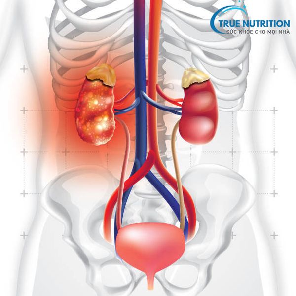 Cảnh Báo: Nắng Nóng Gay Gắt Làm Trầm Trọng Bệnh Thận Mãn Tính