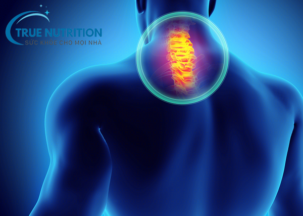 Chẩn đoán thoái hóa đốt sống cổ