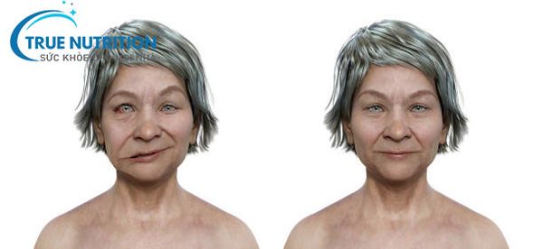 Liệt dây thần kinh số 7 có gây nguy hiểm tính mạng hay không?