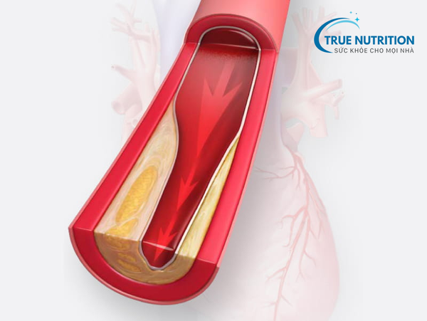 Biến Chứng Mạch Máu Lớn Của Bệnh Tiểu Đường