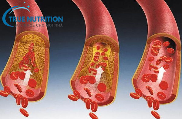Biến Chứng Mạch Máu Nhỏ Của Bệnh Tiểu Đường