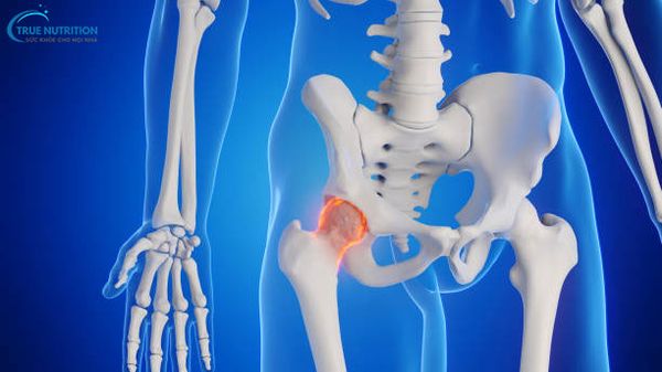 Chỏm Xương Đùi Là Gì? Hoại Tử Chỏm Xương Đùi Là Gì? Dấu Hiệu, Điều Trị, Bài Tập