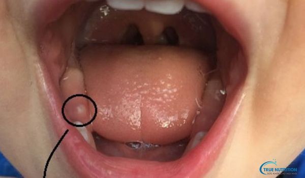 Nhận Diện Hình Ảnh Lợi Trẻ Sắp Mọc Răng: Dấu Hiệu, Chăm Sóc