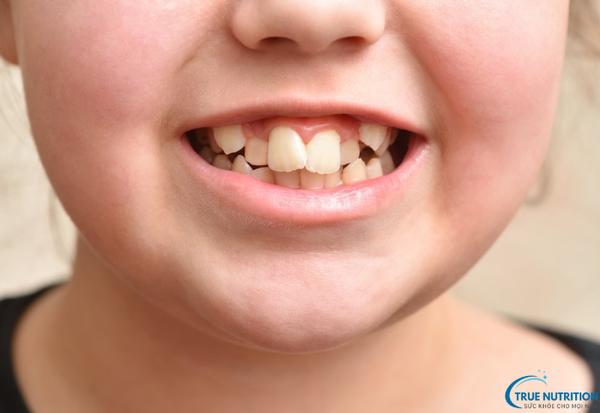 Khớp Cắn Lệch: Dấu Hiệu Nhận Biết và Giải Pháp Cho Nụ Cười Hoàn Hảo