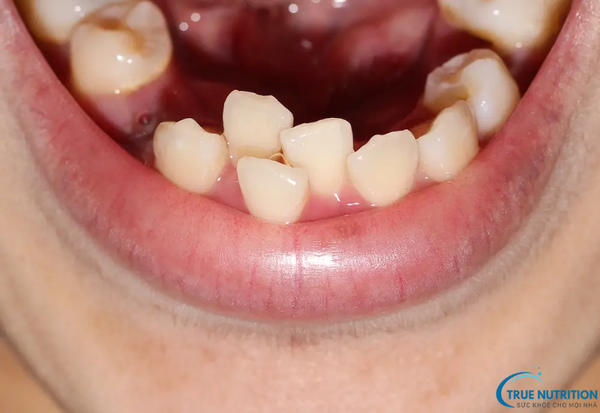 Khớp Cắn Lệch: Dấu Hiệu Nhận Biết và Giải Pháp Cho Nụ Cười Hoàn Hảo