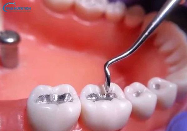 Tác Hại Của Việc Trám Răng, Chi Phí, Tuổi Thọ, Chăm Sóc