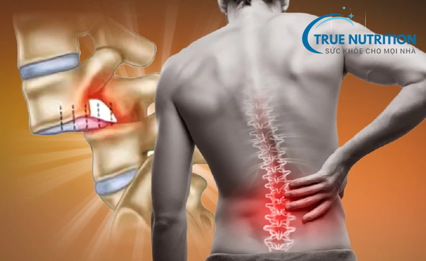 Nguyên nhân thoái hóa đốt sống thắt lưng