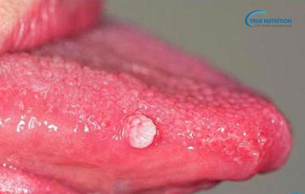 Lưỡi Nổi Hạt: Nguyên Nhân, Triệu Chứng và Cách Phòng Tránh