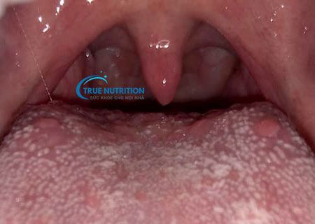 Lưỡi Nổi Hạt: Nguyên Nhân, Triệu Chứng và Cách Phòng Tránh