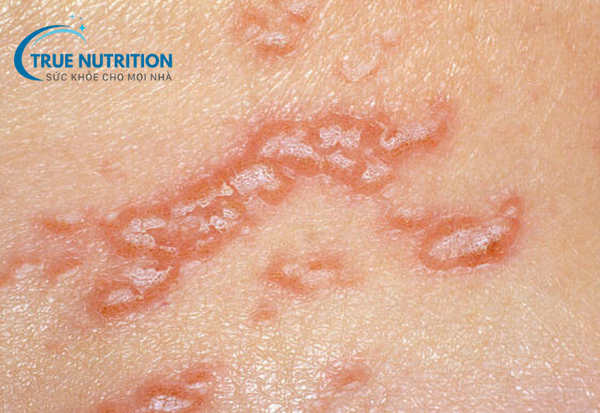 Mụn Rộp Sinh Dục: Tất Cả Những Điều Cần Biết Và Cách Phòng Ngừa