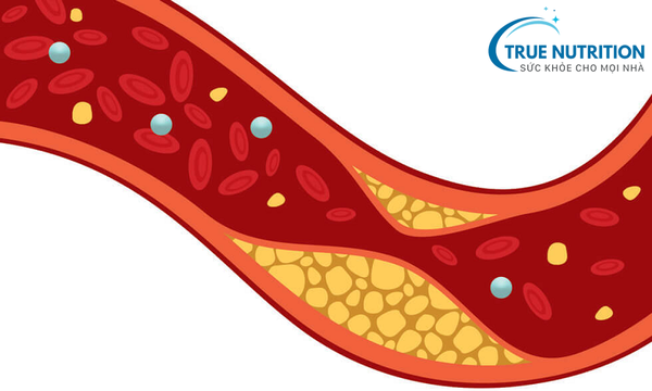 Biến Chứng Mạch Máu Lớn Của Bệnh Tiểu Đường