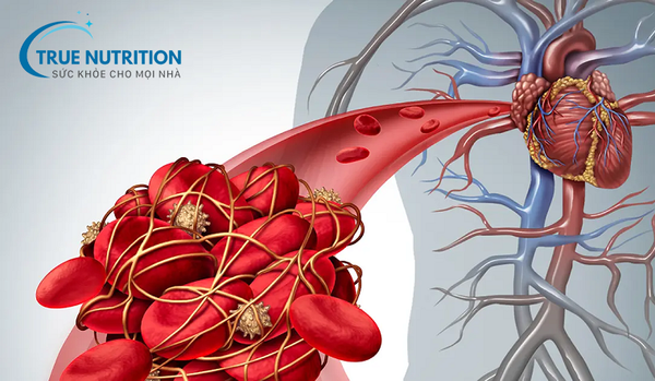 Biến Chứng Mạch Máu Lớn Của Bệnh Tiểu Đường