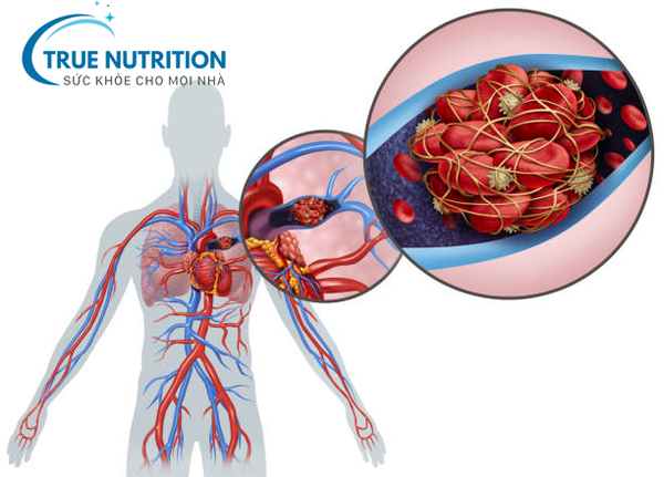 Biến Chứng Mạch Máu Lớn Của Bệnh Tiểu Đường