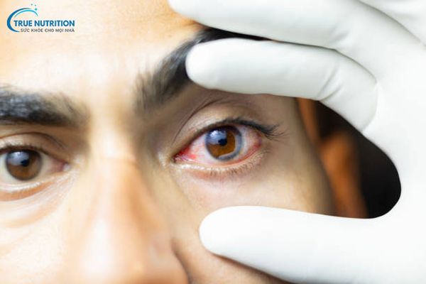 5 Mẹo Chữa Ngứa Khóe Mắt. Ngứa Khóe Mắt Liệu Có Nguy Hiểm Không?