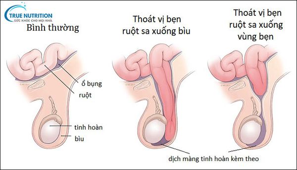 Hình Ảnh Thoát Vị Bẹn Ở Bé Trai: Nhận Biết, Phân Biệt Và Điều Trị