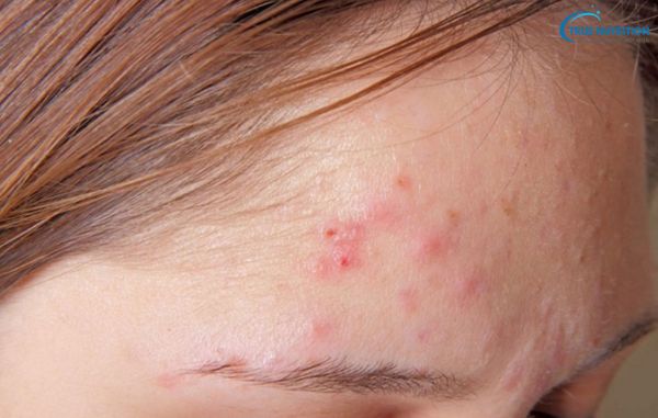 Cách Trị Demodex Tại Nhà: An Toàn Và Hiệu Quả