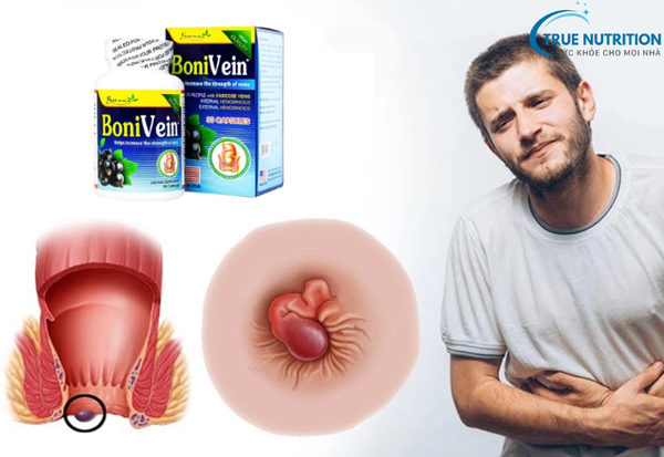 Bonivein 60 Viên Giá Bao Nhiêu: Giải Pháp Hiệu Quả Cho Bệnh Trĩ