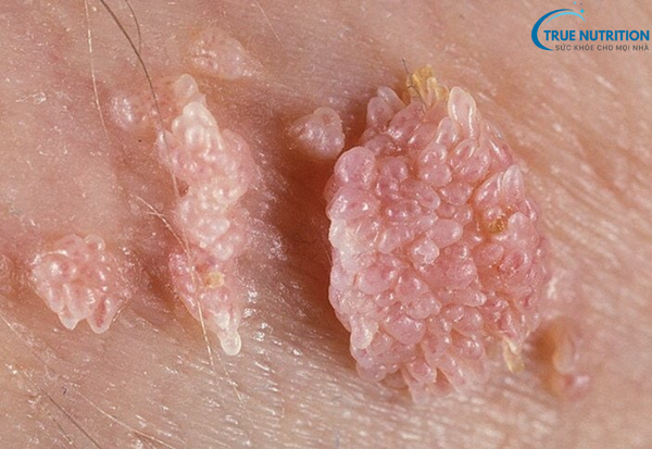 Sùi Mào Gà: Triệu Chứng Bạn Cần Biết Để Phát Hiện Và Can Thiệp Sớm