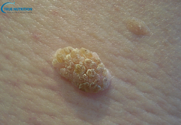 Sùi Mào Gà: Triệu Chứng Bạn Cần Biết Để Phát Hiện Và Can Thiệp Sớm