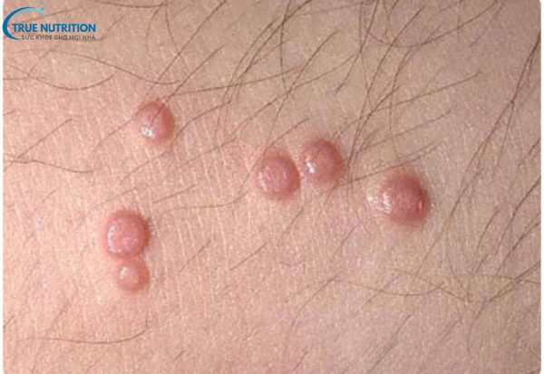 Sùi Mào Gà: Triệu Chứng Bạn Cần Biết Để Phát Hiện Và Can Thiệp Sớm