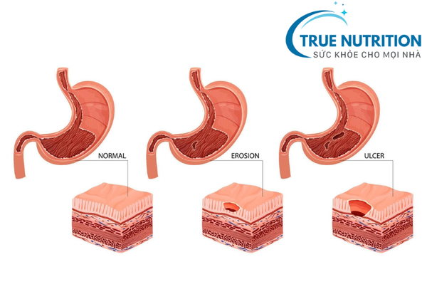teo niêm mạc dạ dày có nguy hiểm không