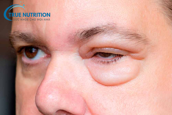 Tiểu Đường Bị Phù Mắt