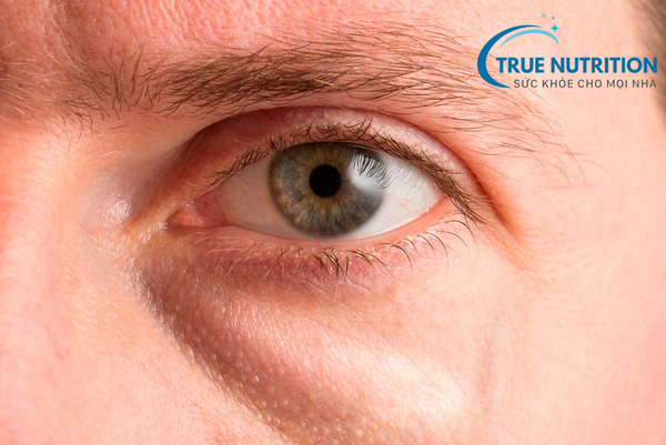 Tiểu Đường Bị Phù Mắt